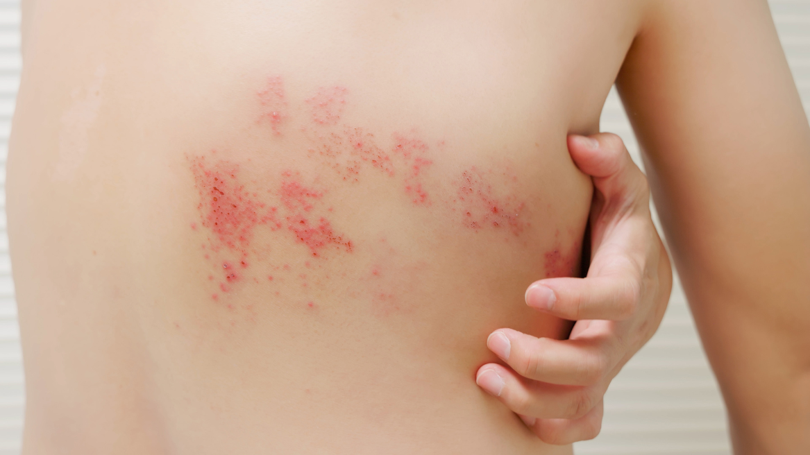 Red, blistering shingles rash on the side of their torso.